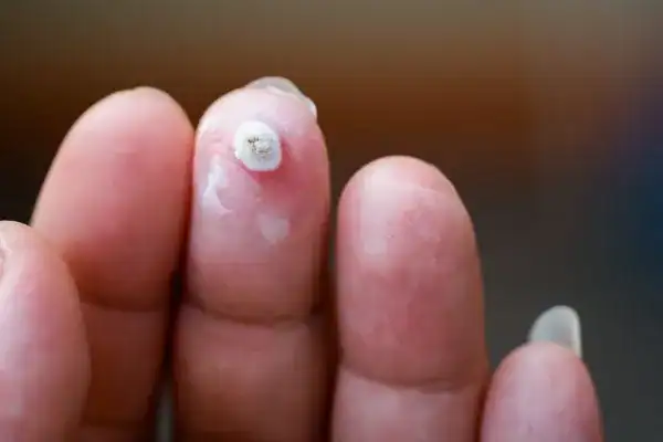 Image of white wart before cryopen treatment Tamworth