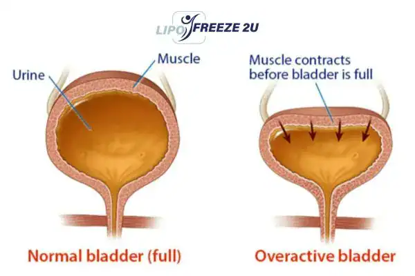 diagram of overactive bladder treatment Tamworth