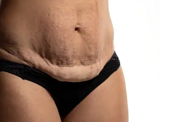 loose skin after weight loss injections Tamworth