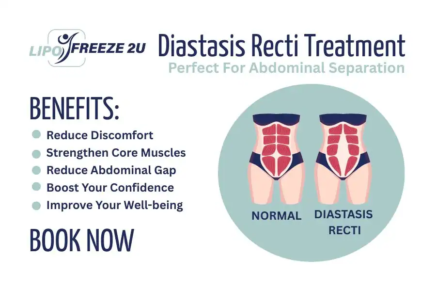 Benefits of body toning treatment Tamworth for Diastasis recti