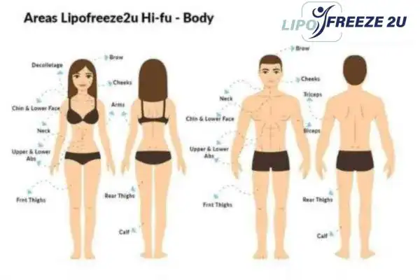 image of areas of the body and HIFU prices Tamworth