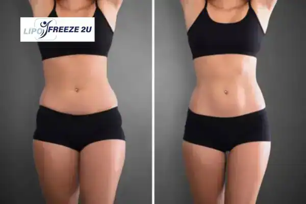 How Can LIPO FREEZE 2U Support Your Post-Pregnancy Body Recovery Tamworth?