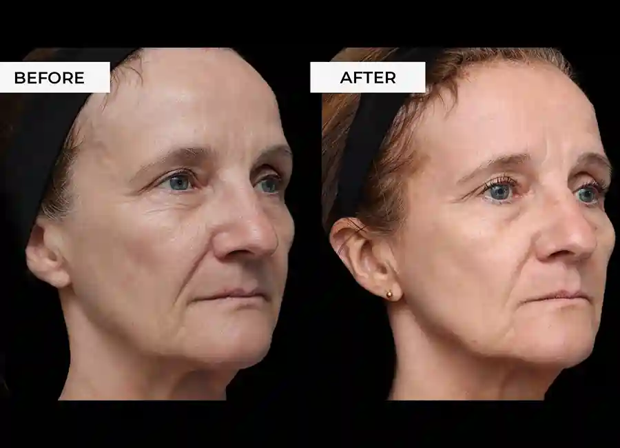 How Many RF Microneedling Sessions Will You Need to See a Difference Tamworth?