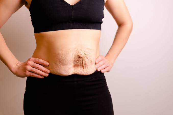 Is Surgery Really the Only Way to Repair Diastasis Recti Tamworth?
