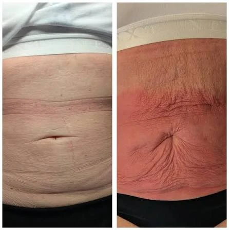 How Does RF Microneedling Improve Crepey, Thin and Uneven Skin Texture Tamworth?