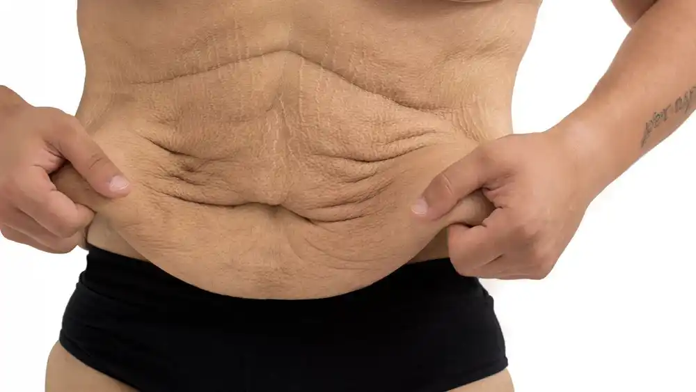 Why Does Weight Loss Medication Leave Some People With Loose or Sagging Skin Tamworth?